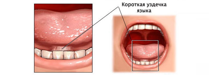 Как в домашних условиях порвать уздечку Как в домашних условиях порвать уздечку